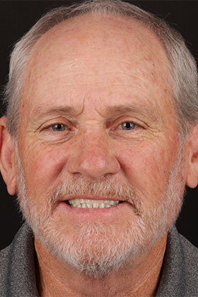 Patient enjoying a stunning new smile after All-on-X dental implants treatment.
